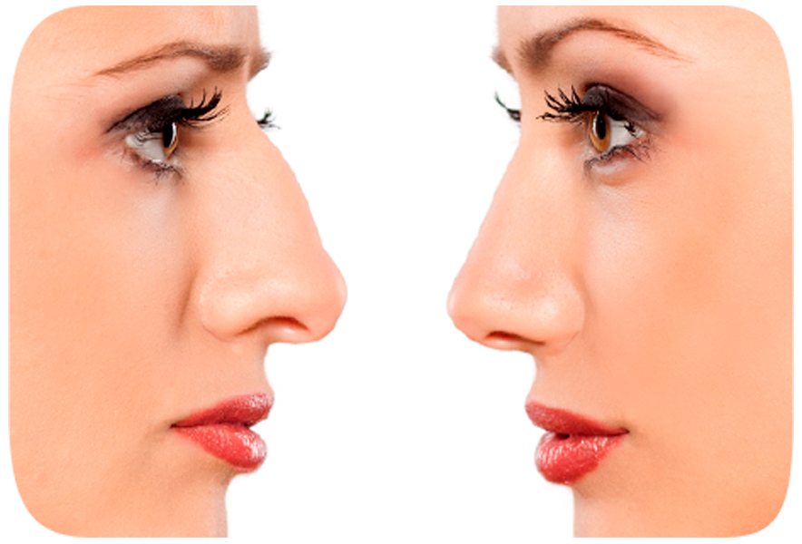 Rinoplastia